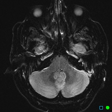 File:Brain death on MRI and CT angiography (Radiopaedia 42560-45689 Axial ADC 9).jpg