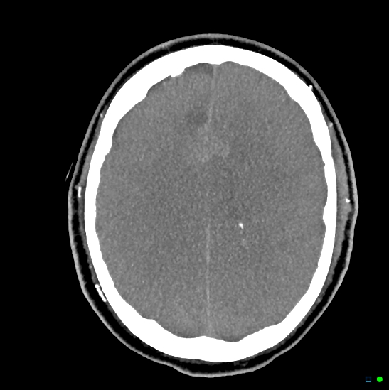 Brain death on MRI and CT angiography (Radiopaedia 42560-45841 B 20).jpg
