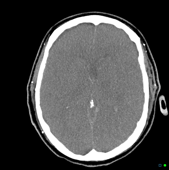 Brain death on MRI and CT angiography (Radiopaedia 42560-45841 B 27).jpg