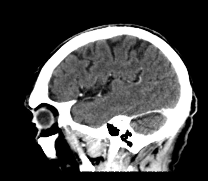 Brain metastases from lung cancer (Radiopaedia 27849-28092 Sagittal C+ delayed 48).jpg