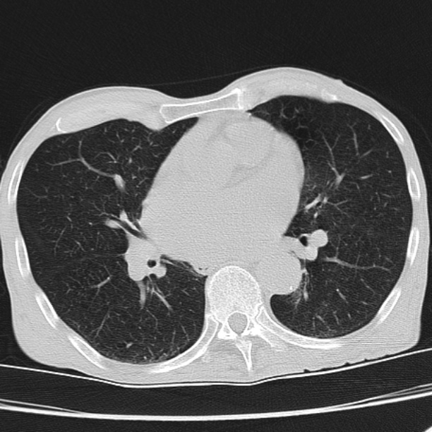 Brain metastases from lung cancer (Radiopaedia 27849-28093 Axial lung window 37).jpg