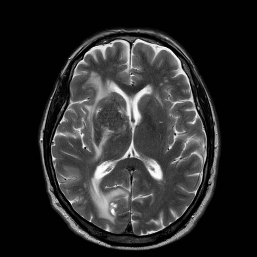 File:Brain metastases from lung cancer (Radiopaedia 83839-99028 Axial T2 19).jpg