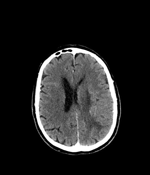 Brain metastasis (large cystic mass) (Radiopaedia 47497-52106 Axial C+ 40).png