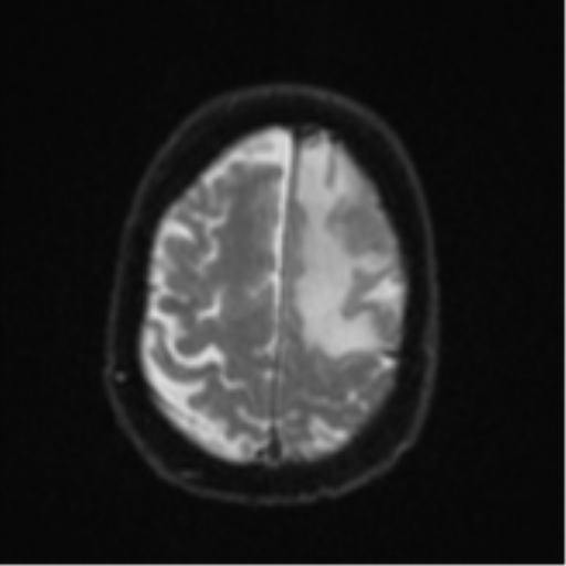 File:Brain metastasis (lung cancer) (Radiopaedia 48289-53179 Axial DWI 23).png