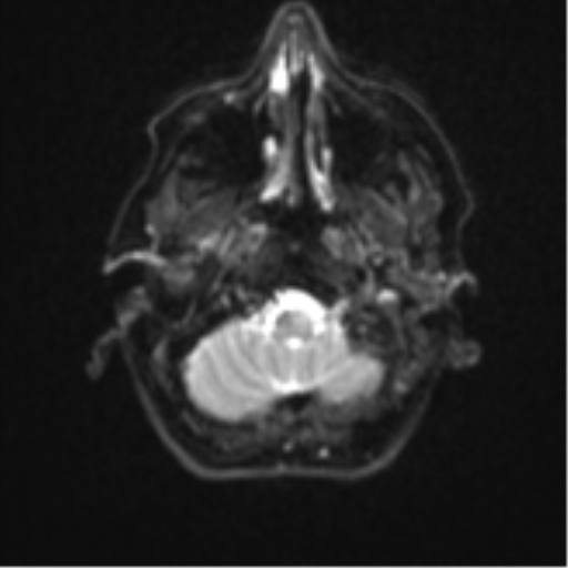 Brain metastasis (sarcoma) (Radiopaedia 47576-52209 Axial DWI 4).png