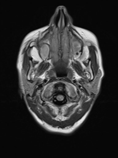 File:Brain metastasis as initial presentation of non-small cell lung cancer (Radiopaedia 65122-74126 Axial FLAIR 2).jpg
