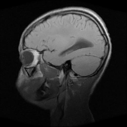 File:Brainstem glioma (Radiopaedia 30923-31624 Sagittal T1 5).jpg