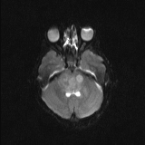 Brainstem glioma (Radiopaedia 67531-76922 Axial DWI 8).jpg
