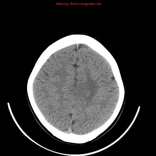 File:Brainstem glioma (Radiopaedia 9444-10123 non-contrast 19).jpg
