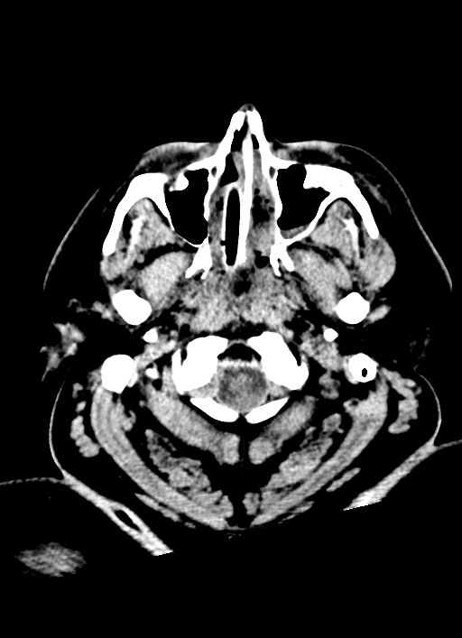 Brainstem hemorrhage (Radiopaedia 81294-94976 Axial non-contrast 59).jpg