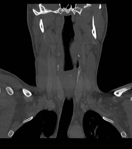 Branchial cleft cyst (Radiopaedia 31167-31875 Coronal bone window 33).jpg