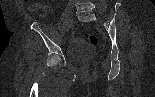 Breast carcinoma with pathological hip fracture (Radiopaedia 60314-67993 Coronal bone window 72).jpg