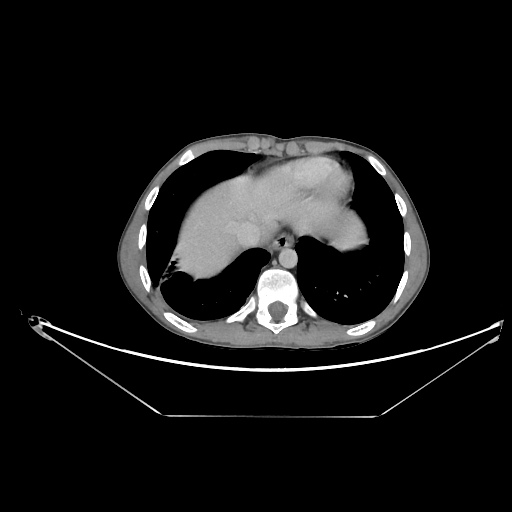 Bronchial carcinoid tumor (Radiopaedia 57187-64090 A 62).jpg