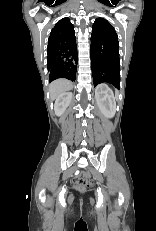 Bronchial carcinoid tumor (Radiopaedia 57187-64090 B 94).jpg