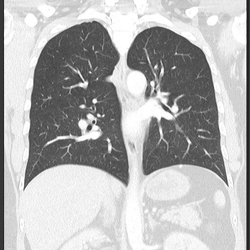 Bronchial carcinoid tumor (Radiopaedia 67377-76764 Coronal lung window 41).jpg