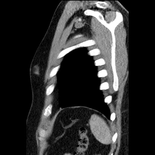Bronchial carcinoid tumor (Radiopaedia 67377-76764 E 61).jpg