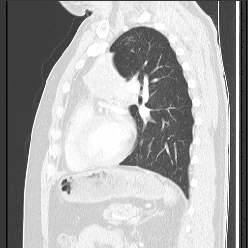 File:Bronchial carcinoid tumor (Radiopaedia 67377-76764 Sagittal lung window 45).jpg