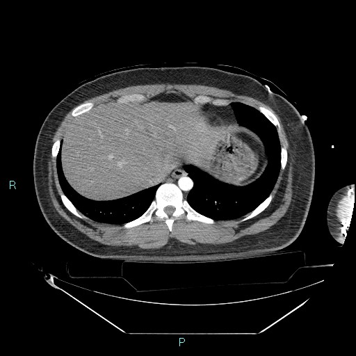 File:Bronchial carcinoid tumor (Radiopaedia 78272-90870 B 100).jpg