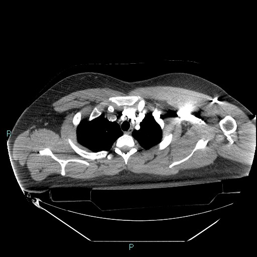 Bronchial carcinoid tumor (Radiopaedia 78272-90870 B 27).jpg