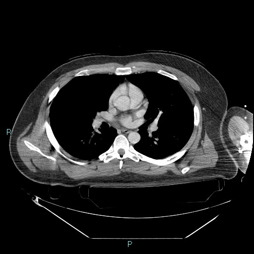 Bronchial carcinoid tumor (Radiopaedia 78272-90870 C 60).jpg