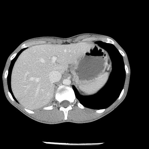 Bronchial carcinoid tumor causing right lower lobe collapse (Radiopaedia 83495-98594 A 51).jpg