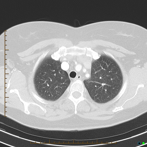 File:Bronchial diverticula (Radiopaedia 79512-92675 Axial lung window 11).jpg