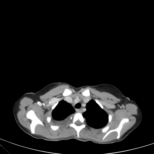 Bronchial mucoepidermoid carcinoma (Radiopaedia 57023-63895 Axial 20).jpg