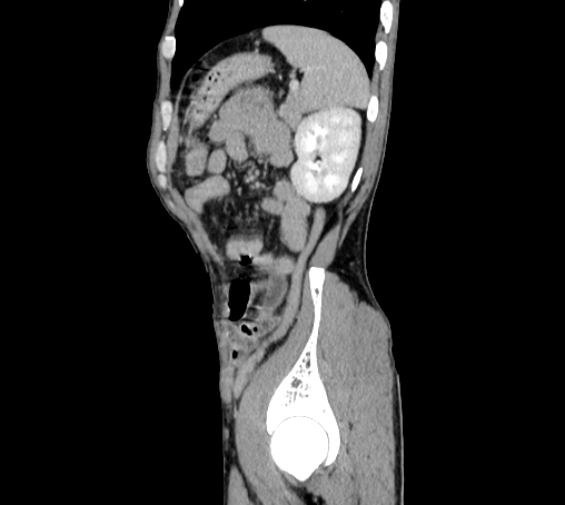 File:Bronchiectasis in Crohn disease (Radiopaedia 60311-67977 D 95).jpg