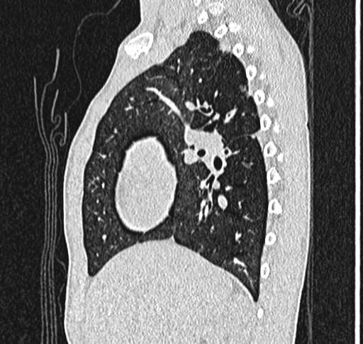 Bronchiolitis obliterans (Radiopaedia 71538-81897 Sagittal lung window 23).jpg