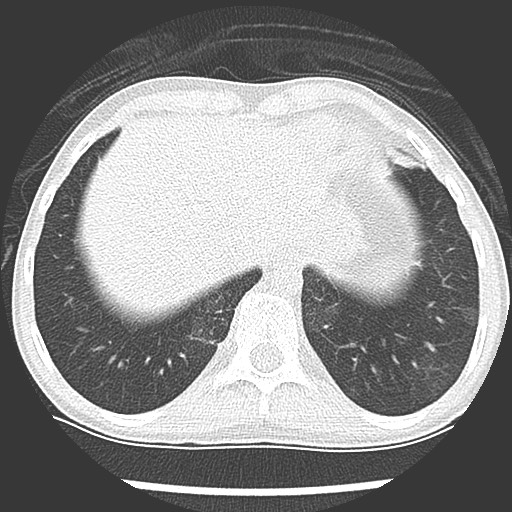 File:Bronchiolotis obliterans (Radiopaedia 73769-84575 Axial lung window 40).jpg