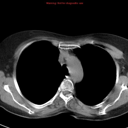 File:Bronchoalveolar carcinoma (BAC) (Radiopaedia 13436-13392 Axial non-contrast 15).jpg