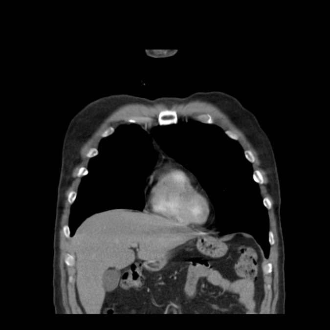 Bronchogenic carcinoma with upper lobe collapse (Radiopaedia 29297-29726 D 16).jpg