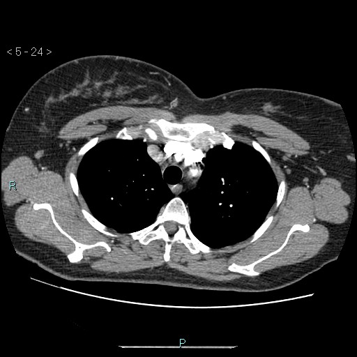File:Bronchogenic cyst - posterior mediastinal (Radiopaedia 43885-47364 A 14).jpg