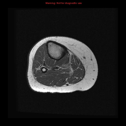 File:Brown tumor (Radiopaedia 12318-12597 Axial T1 17).jpg