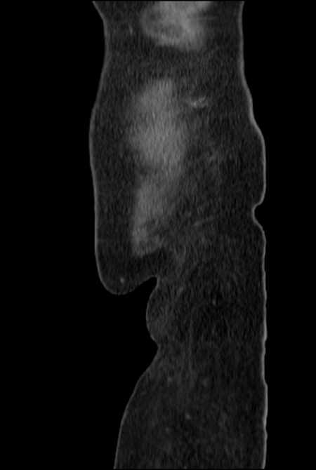 Brown tumors compressing the spinal cord (Radiopaedia 68442-77988 F 56).jpg
