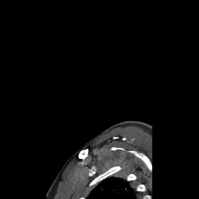 Buccal fat pad arteriovenous malformation (Radiopaedia 70936-81144 C 79).jpg