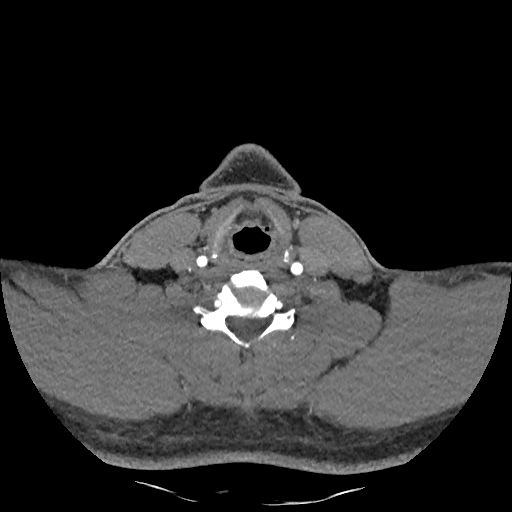 Buccal fat pad arteriovenous malformation (Radiopaedia 70936-81144 D 106).jpg