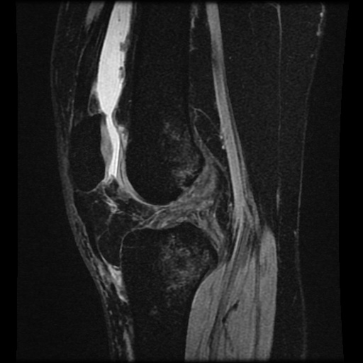 Bucket handle meniscus tear (Radiopaedia 56916-63751 H 39).jpg