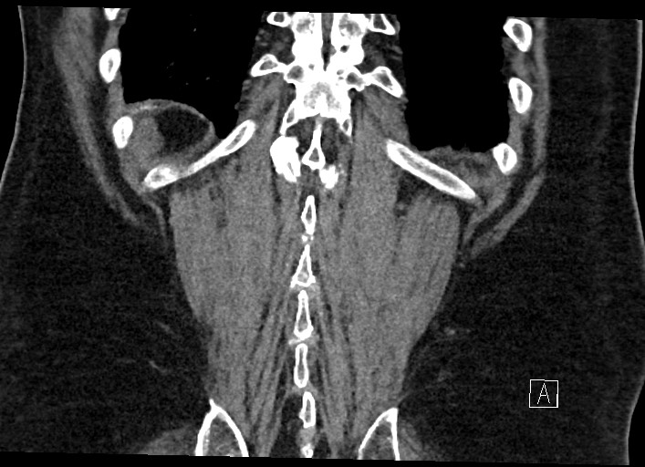 Buried bumper syndrome - gastrostomy tube (Radiopaedia 63843-72577 Coronal Inject 123).jpg