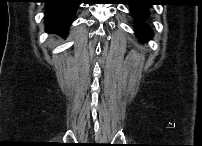 File:Buried bumper syndrome - gastrostomy tube (Radiopaedia 63843-72577 Coronal Inject 126).jpg