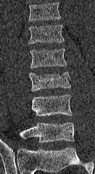 File:Burst fracture (Radiopaedia 53373-59357 Coronal bone window 32).jpg