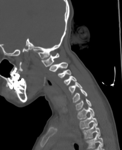 File:Butterfly vertebra (Radiopaedia 77903-90209 Sagittal bone window 73).jpg