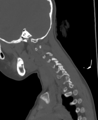 File:Butterfly vertebra (Radiopaedia 77903-90209 Sagittal bone window 97).jpg