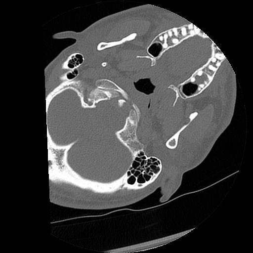 C1-C2 "subluxation" - normal cervical anatomy at maximum head rotation (Radiopaedia 42483-45607 Axial non-contrast 63).jpg