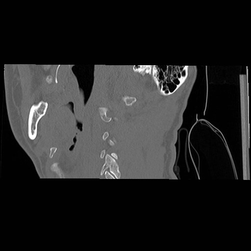 File:C1-C2 "subluxation" - normal cervical anatomy at maximum head rotation (Radiopaedia 42483-45607 C 57).jpg