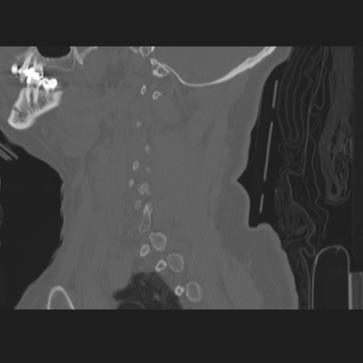 C2 fracture (Radiopaedia 34091-35341 Sagittal bone window 55).png