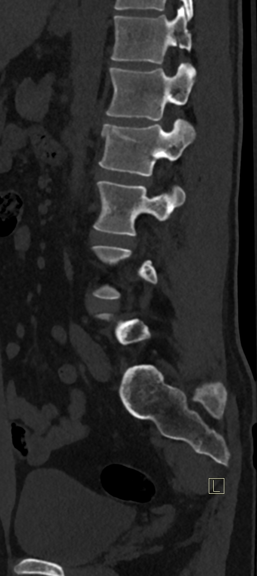 Calcaneal fractures with associated L2 burst fracture (Radiopaedia 71671-82493 Sagittal bone window 22).jpg