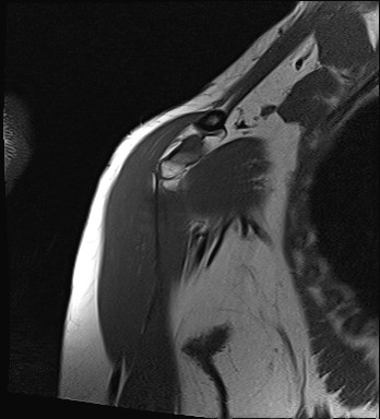 File:Calcific tendinitis of the infraspinatus tendon (Radiopaedia 87256-103537 Coronal T1 5).jpg
