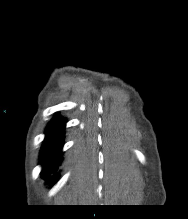Calcified cerebral emboli from left ventricular thrombus (Radiopaedia 84420-99760 Coronal C+ CTPA 6).jpg