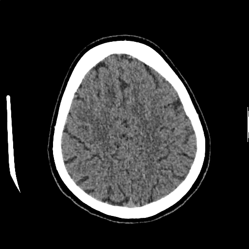 Calcified cerebral hydatid cyst (Radiopaedia 65603-74717 Axial non-contrast 60).jpg